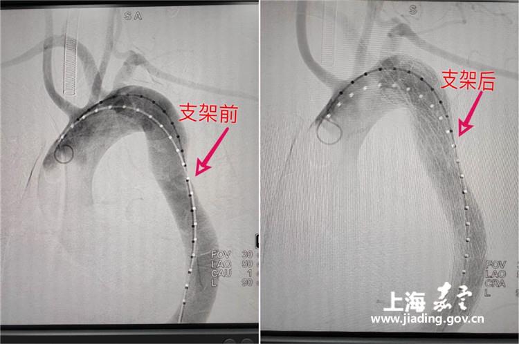 许向东团队通过微创介入治疗——主动脉造影 覆膜支架植入术,在不开胸