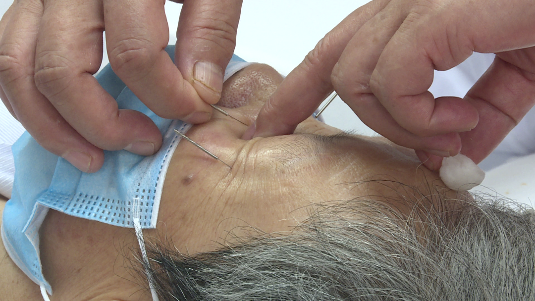 彭氏眼针学术流派传承人王鹏琴对患者望闻问切后,根据病情,熟练地在